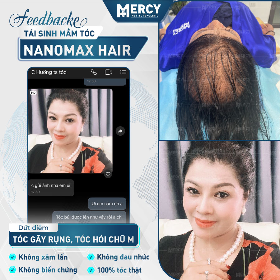 Feedback khách hàng điều trị rụng tóc Nanomax Hair