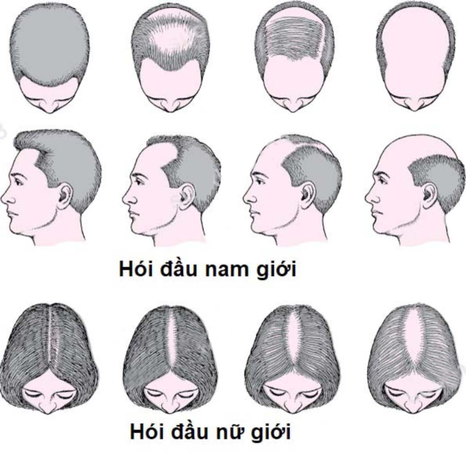 Các dạng hói đầu ở nam và nữ