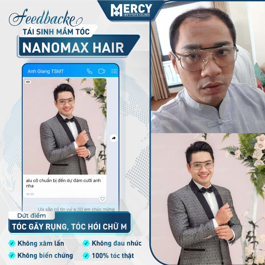 Feedback khách hàng điều trị rụng tóc, hói đầu với công nghệ Nanomax Hair