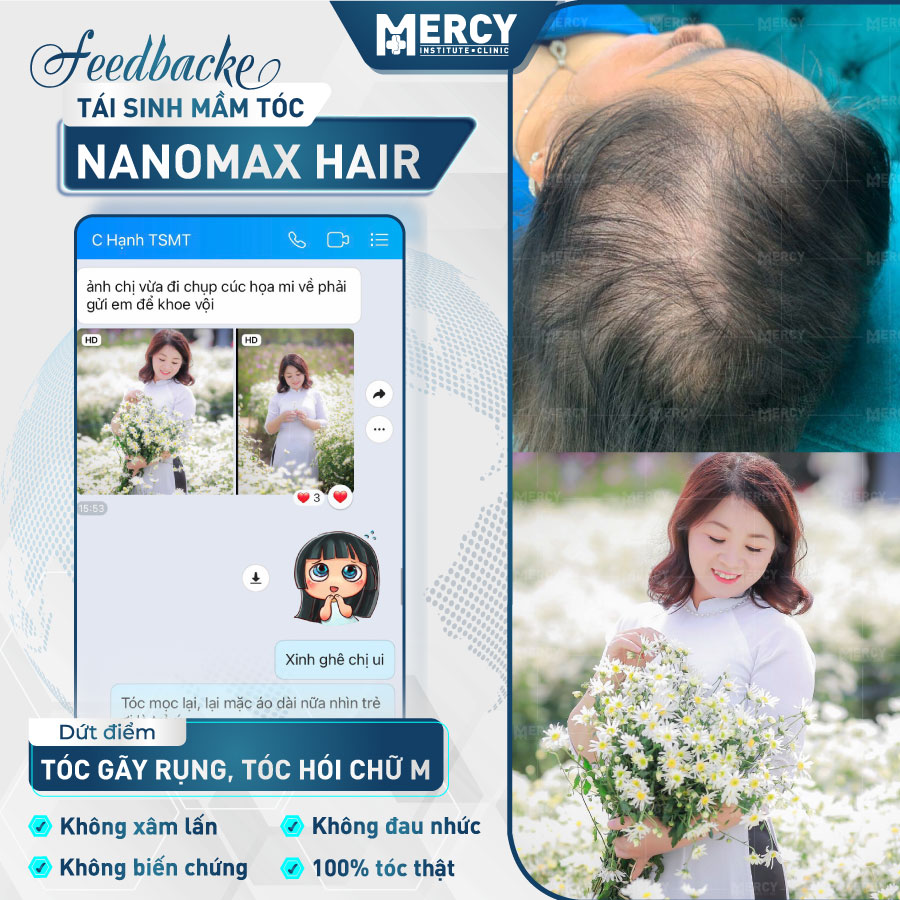 Feedback khách hàng điều trị rụng tóc với công nghệ Nanomax Hair