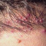 Điều gì gây ra viêm nang lông ở đầu và cách khắc phục