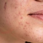 Cách chăm sóc da để tránh viêm nang lông ở mặt