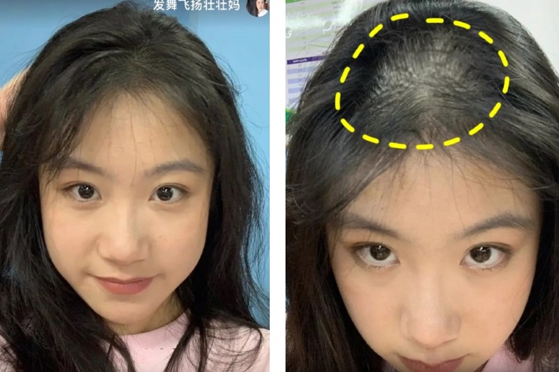 Rụng tóc hói đầu ở nữ: Nguyên nhân, triệu chứng và cách điều trị