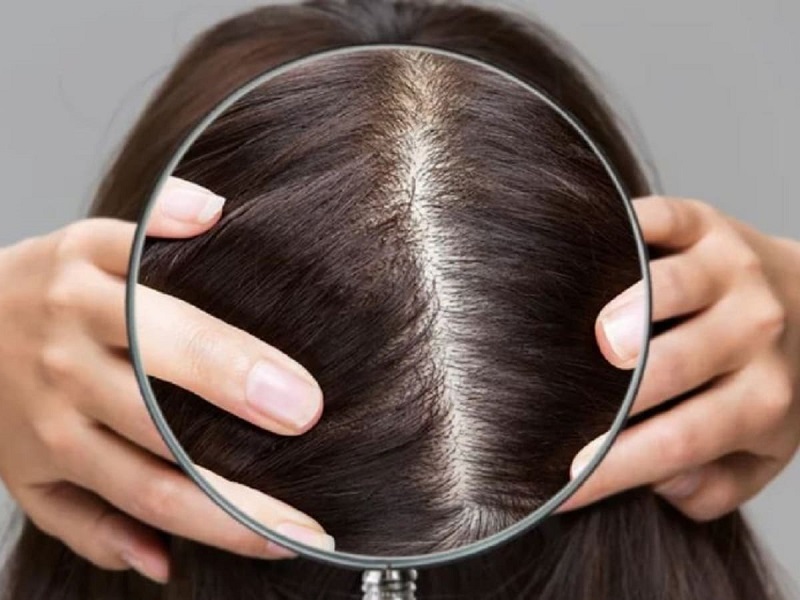 Nguyên nhân rụng tóc hói đầu ở nữ