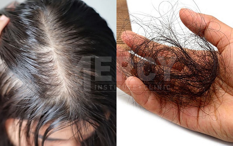 Các nguyên nhân gây ra rụng tóc hói đầu ở nữ có thể được chia thành các nhóm