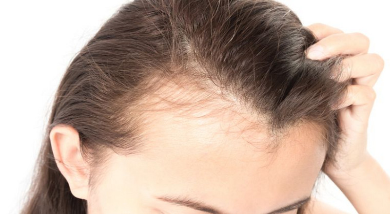 Các nguyên nhân chính gây ra rụng tóc ở phụ nữ tuổi trung niên