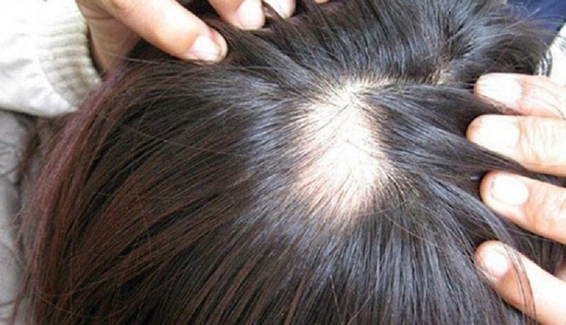 Các nguyên nhân gây ra rụng tóc từng mảng